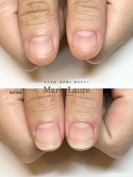 マリーロール 梅田店(Marie Laure)/自爪育成/深爪矯正/ネイルケア