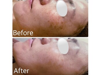 ブランシェ 金沢店 × 椿/シミケア　お客様