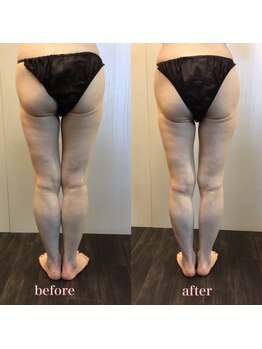 ラウレア 松山店(LAULEA)/ハイパーナイフ痩身before/after