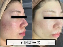 【実績】肌トラブル・赤ら顔も劇的な変化改善