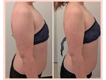 ワイズ(Y's)/背中&二の腕５回目