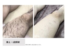 リネ(Rine)/before→after