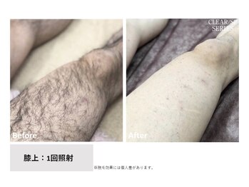 リネ(Rine)/before→after