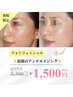 光フォト☆肌にハリをだしたい方◇１回で劇的効果◎エイジングケア