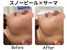 ラディアント たまプラーザ/スノーピール×サーマトリックス