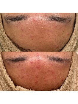 シャルム(Charme)/メンズフェイシャル♪ニキビケア