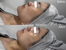 ナチュールムーン(Nature moon.)/ハーブピーリング