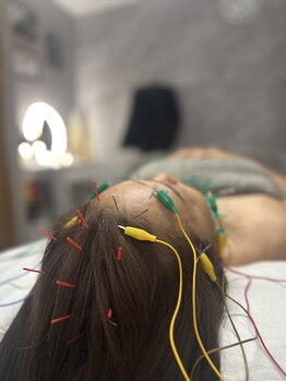 ルミア(LUMiA)の写真/丁寧なカウンセリングと痛みの少ない美容鍼で初めての方にもオススメ◎電気を流すことで効果UPも♪
