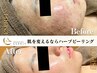 AI肌診断で肌を深堀!人気!ハーブピーリング!REVI+生酵素300♪90分9.900円
