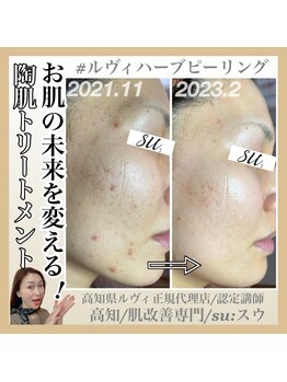 スー(su:)/頑固な肌荒れも必ず綺麗に！！