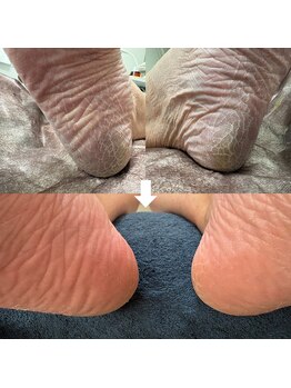 ビビィ(vivie)/ガサガサかかと、お任せください