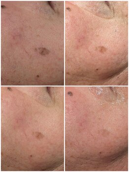 トリニティスペース(TrinitySpace)/シミケア×プラズマフェイシャル