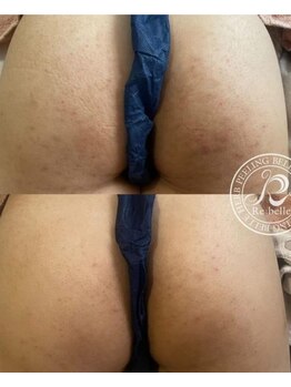 クリア 麻布十番(CLEAR)/リベルハーブピーリング　おしり