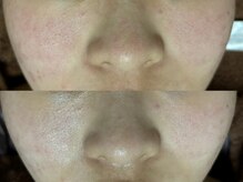 リボーン(REBORN)/肌質改善ケア