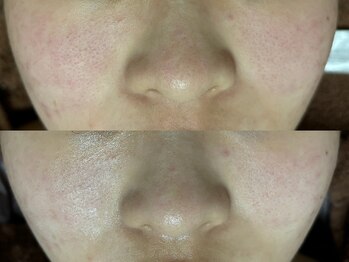 リボーン(REBORN)/肌質改善ケア