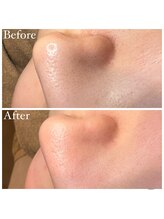 マドモアゼル 麻布十番/毛穴洗浄