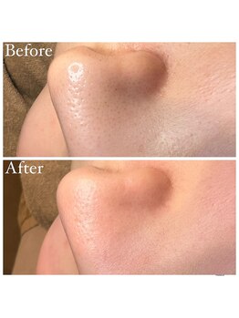 マドモアゼル 麻布十番/毛穴洗浄