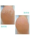 本格角質ケア