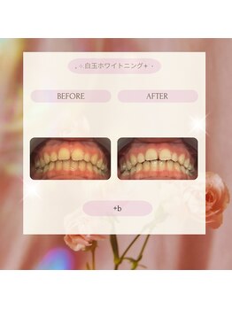 プラスビーセルフ(+b self)/ホワイトニングビフォーアフター