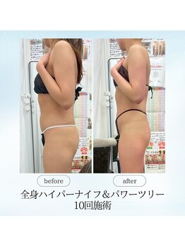 エスプレッソ(espresso,)/【全身痩身10回】お体の厚み撃退