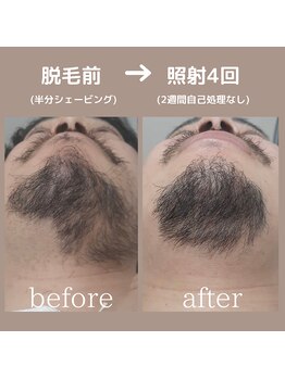 モーイ(mooi)/men'sヒゲ脱毛