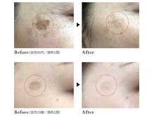 プランス 福岡(PLANCE)/シミケア　福岡天神エステ　乾燥