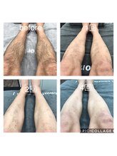 ボーテ デ ソレイユ(beaute de soleil)/メンズ・見える部分の脱毛も人気