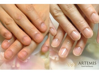 アルテミス(ARTEMIS)/深爪育成コース