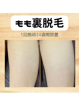 ビクト(Vict)/高校生の脱毛も♪