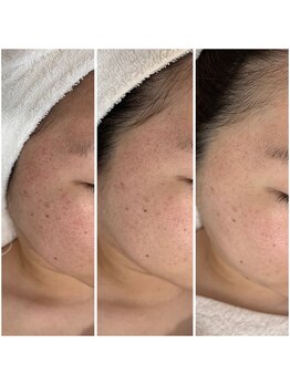 プラセル(Placer)/3ヵ月の変化