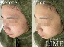 ライム 札幌(LIME)/ハーブピーリング|ニキビケア