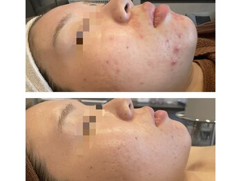 サロン ド フェイス モアナ(Salon de Faith Moana)/フォト光フェイシャル