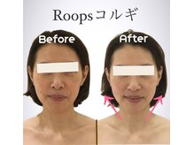 ループス(Roops)/ビフォーアフター【コルギ】