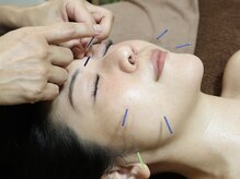 ティルナノーグイリニ(Tir Na Nog-EIRINI)/顔の巡りを整える鍼