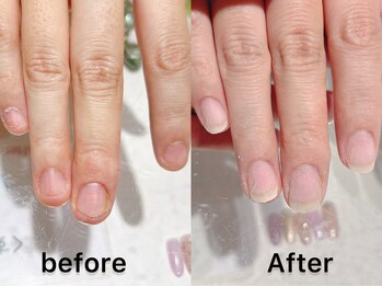 深爪矯正お気軽に♪／西所沢駅