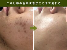 アンテサロン 関内店(Antesalon)/ハーブピーリングBefore&After