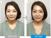 ワト(WATO)/■小顔施術（before→after)