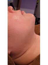 サロンドカイ(Salon de Kai)/カーボンフェイシャル　１回