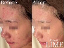 ライム 札幌(LIME)/ハーブピーリング|ニキビケア