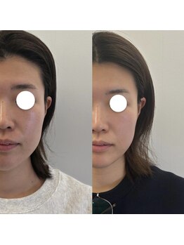 ホロニック ベルサンテ(Holonic Belle Sante)/ほうれん線/リフトアップ