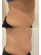 ルナート(Lunart)/腸もみの一回の変化