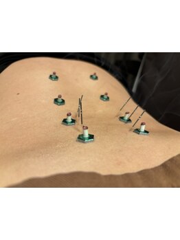 鍼灸施術を受けたい