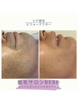 ベベ(Bebe)/ヒゲ脱毛