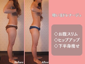 エステティックサロンティエリー/吸い玉ドレナージュ