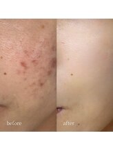 アーネスト 大阪心斎橋店(EARNEST)/究極肌管理【 ニキビトラブル 】