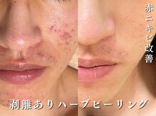 ダリア(Dahlia)/赤みやニキビもなかったことに