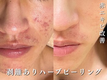 ダリア(Dahlia)/赤みやニキビもなかったことに