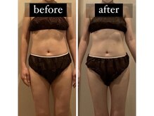 シャリル(CHARIRE)/脂肪冷却比較写真