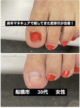 巻き爪じゅん 千葉駅前店/長年隠してきた肥厚爪が改善