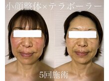 エクレクティック(ECLECTIC)/テラボーラー/小顔整体/小顔